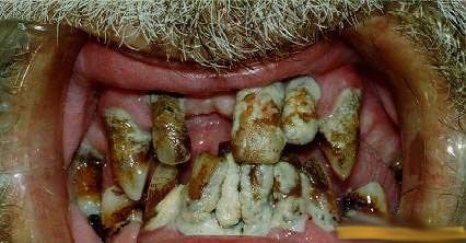 Dents